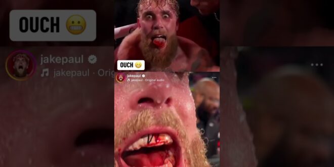 Jake’s left teeth are pushed back in his mouth from AJ’s right hand 👊 #JakeJoshua – Boxing News
