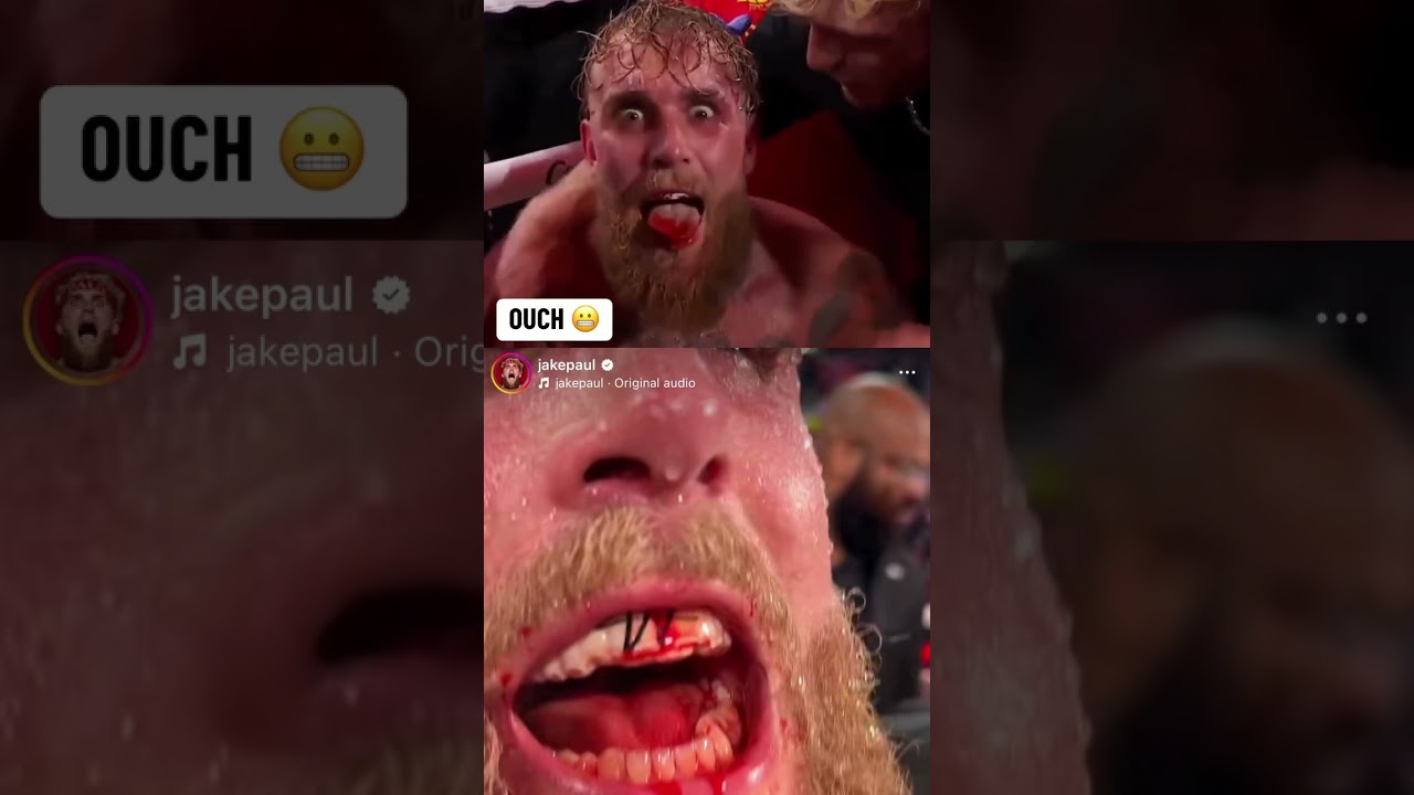 Jakeâ€™s left teeth are pushed back in his mouth from AJâ€™s right hand 👊 #JakeJoshua