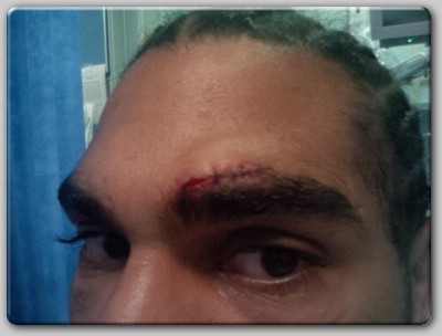 David Haye cut eye